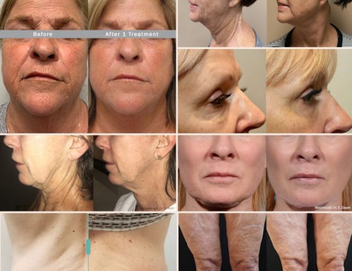 This is an example of women experiencing loose skin before and after using treatments of Morpheus8.