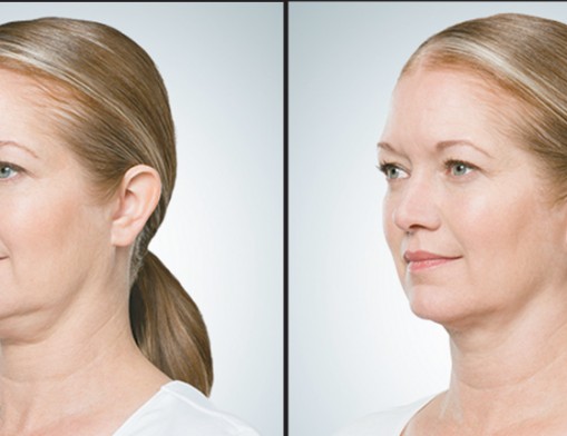 Before and after photos of real patients with real results courtesy of KYBELLA™. Individual results may vary.