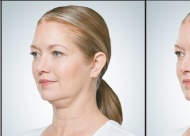 Before and after photos of real patients with real results courtesy of KYBELLA™. Individual results may vary.