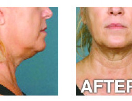 Unretouched photos of clinical trial patient taken before and after three treatment sessions with KYBELLA™. Individual results may vary.