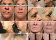 This is an example of women experiencing loose skin before and after using treatments of Morpheus8.
