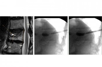 Left image: MRI showing acute fracture with fluid cleft. Middle image: picture during kyphoplasty with balloon in the fracture cleft. 
Right image: Bone glue filling the fracture cleft during kyphoplasty. A typical CT report would eyeball estimate this as 20 percent height loss. Genant Six-Point Semi-Quantitative Analysis (SPSQA) measurements show between 45-55% height loss. (17mm compared to 31mm posterior wall height). 