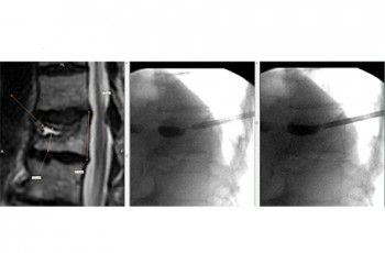 Left image: MRI showing acute fracture with fluid cleft. Middle image: picture during kyphoplasty with balloon in the fracture cleft. 
Right image: Bone glue filling the fracture cleft during kyphoplasty. A typical CT report would eyeball estimate this as 20 percent height loss. Genant Six-Point Semi-Quantitative Analysis (SPSQA) measurements show between 45-55% height loss. (17mm compared to 31mm posterior wall height). 