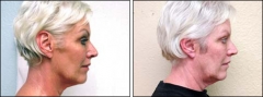 Before and after Ultherapy. (Real patient)